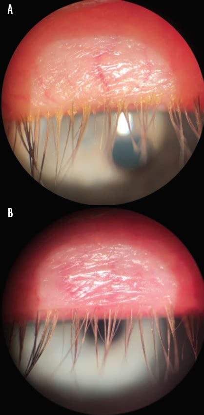 A Guide To Managing Blepharitis Modern Optometry