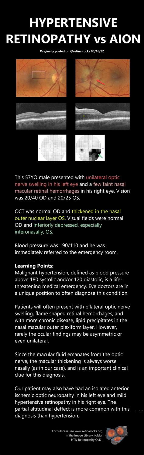 Optic Nerve Disorders Optic Neuropathy Retina Rocks