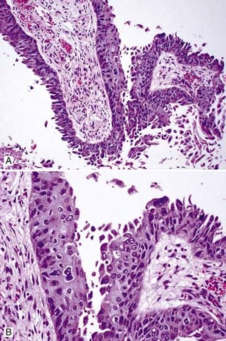 Papillary Variant Of Squamous Cell Carcinoma Scc Thoracic Pathology