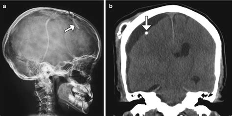 Hydrocephalus Shunt Mri