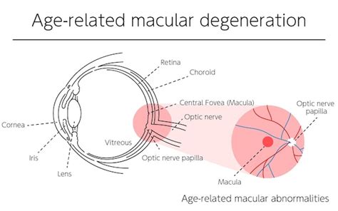 Ilustraci N De La Degeneraci N Macular Relacionada Con La Edad De La