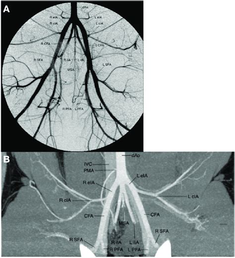 A Dsa Of Distal Aorta Demonstrating The Aortic Trifurcation And