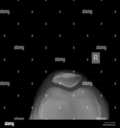 Fractura De R Tula Y La Radiograf A De La Rodilla De Un Paciente Var N