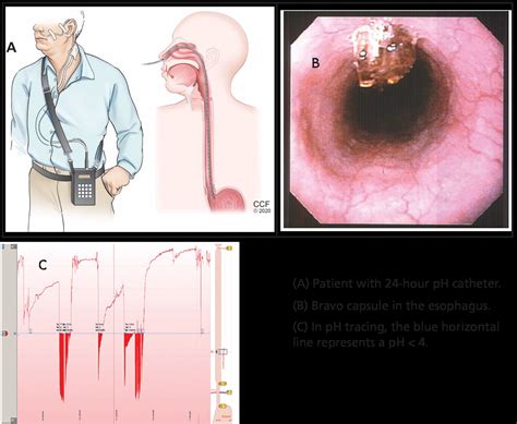 Gerd A Practical Approach Cleveland Clinic Journal Of Medicine