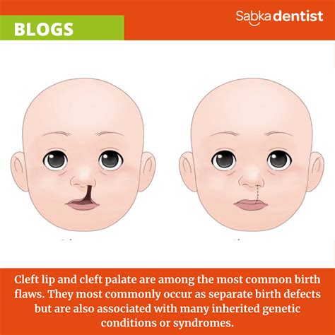 What Every Parent Should Know About Cleft Lip And Palate Cleft Lip