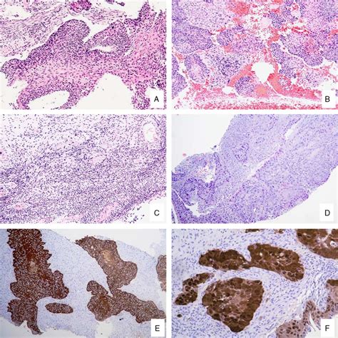 A Cervical Punch Biopsy Revealed The Presence Of Neoplastic Squamous