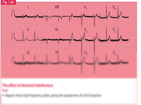 SOLUTION: Ecg examples - Studypool