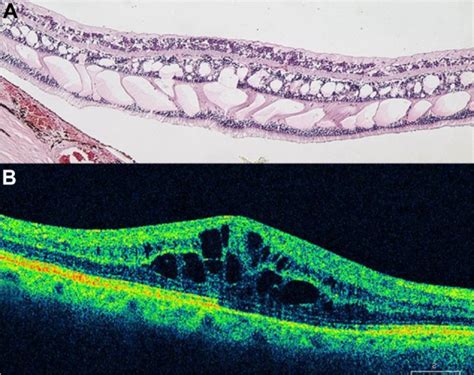 A Histological Cross Section Of CME B SD OCT Cross Section Of