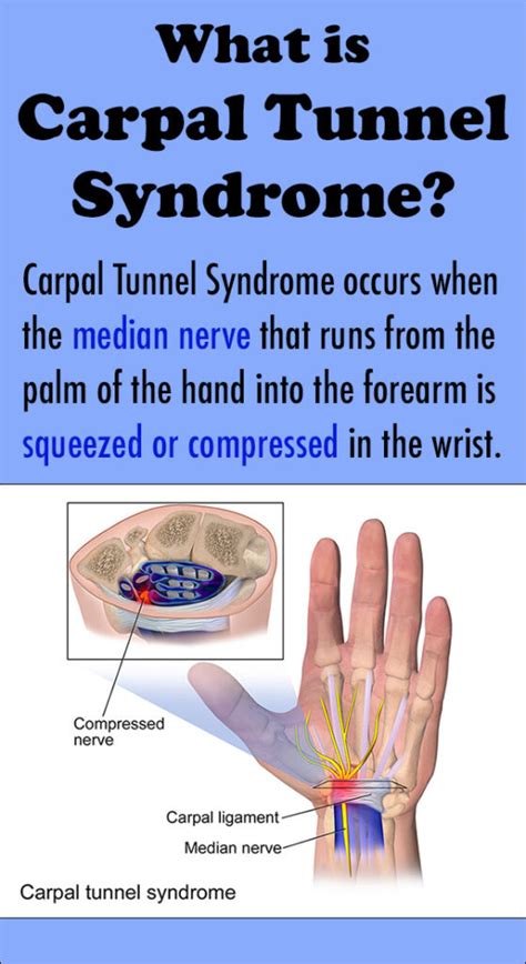 Carpal Tunnel Syndrome Causes And Symptoms Ask The Nurse Expert