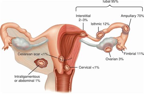 Methotrexate Injection For Ectopic Pregnancy