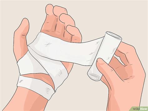 Как лечить волдыри от ожога wikiHow