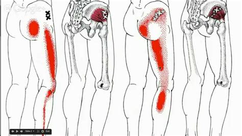 Levy H.: Sciatica pain symptoms hip