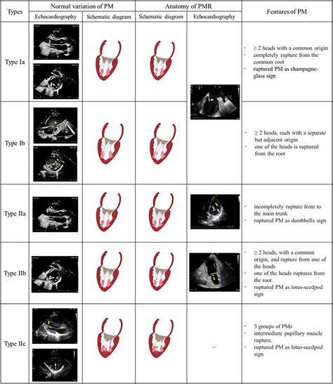 Echocardiographic Diagnosis Of Rupture Of Mitral Valve Papillary Muscle