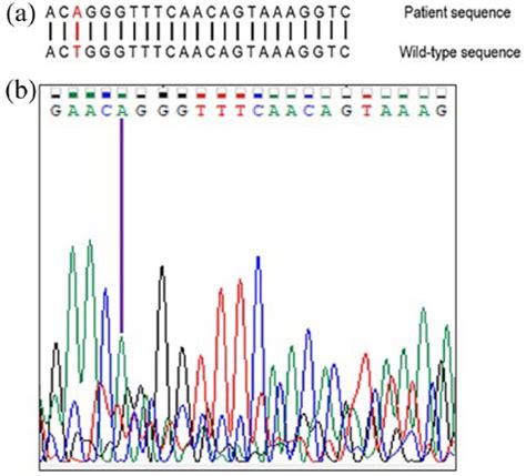 A Wild Type Sequence Of Exon Of Aldob Around Position C And