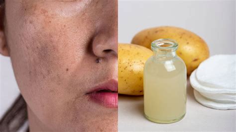 Potato For Dark Spot