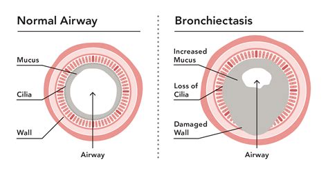 Understanding And Managing Bronchiectasis SmartVest Airway Clearance