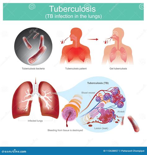 Tuberculosis Tb Infection In The Lungs Stock Vector Illustration Of