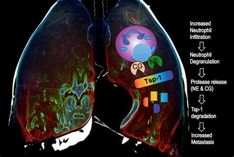 Lung Inflammation Contributes to Metastasis | Newsroom | Weill Cornell ...