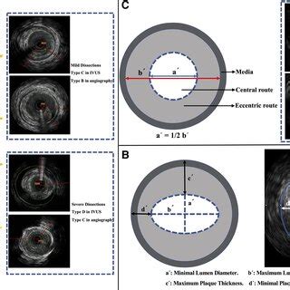 IVUS imaging and characterization. (A) Classification of dissections in ...