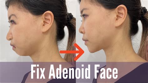 What is Adenoid Face How to Improve | Koko Face Yoga