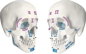 Locking Maxillofacial Mini Arc Bridge Plate Credible Solutions Pvt Ltd