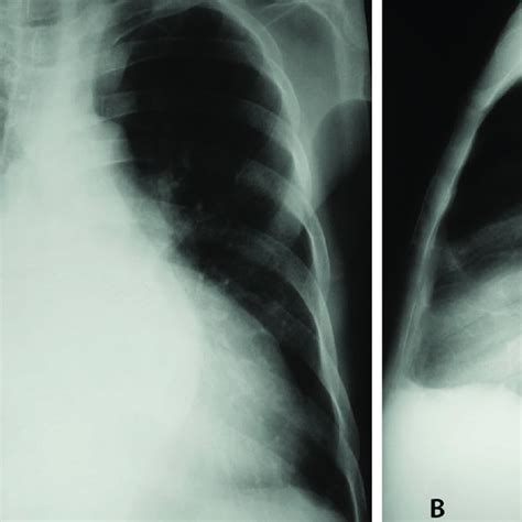 Felson S Classification Of Mediastinum In Anterior Middle And Download Scientific Diagram