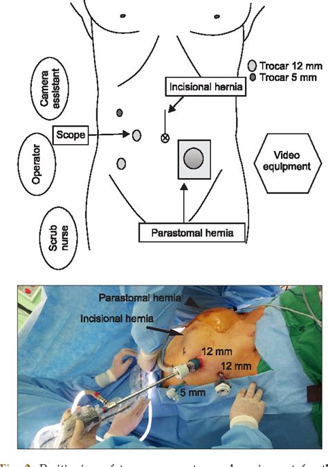 Figure 3 From Laparoscopic Repair Of Parastomal And Incisional Hernias