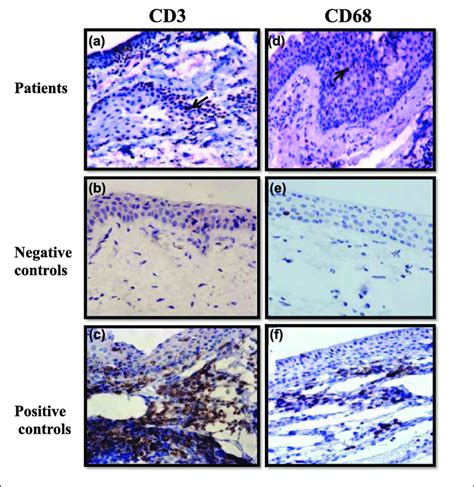 Immunohistochemical Staining For Cd3 A B And C And Cd68 D E And Download Scientific