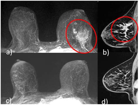 Cancers Free Full Text Staging Breast Cancer With Mri The T A Key