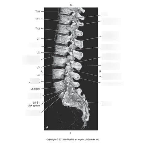 3D CT Of Lateral Lumbar Spine Diagram Quizlet