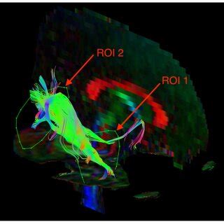 Diffusion tensor tractography of the inferior longitudinal fasciculus... | Download Scientific ...