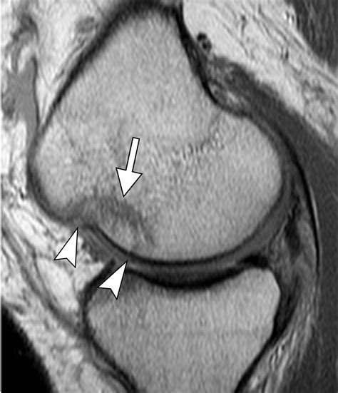 Osteochondral Lesions Of The Knee Differentiating The Most Common