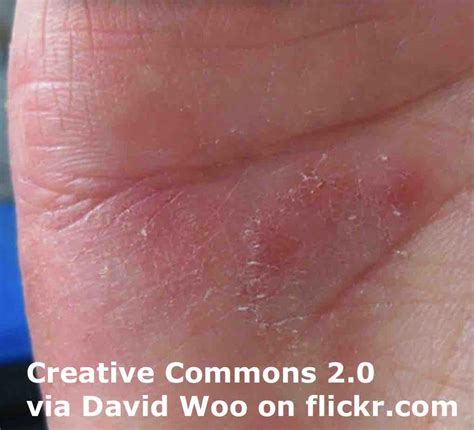 Eczema And Itchiness ESL Lesson Plan Breaking News English Lesson