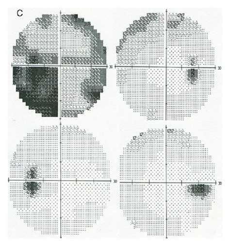 Color fundus in case 3 showed a tessellated myopic fundus with temporal ...