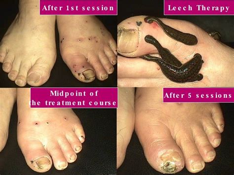 Buergers Disease Leech Therapy