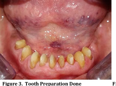 Figure From Mandibular Distal Extension Cast Partial Denture Using