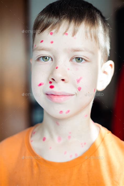 Portrait Of A 10 Year Old Boy With Chickenpox And A Rash On His Face