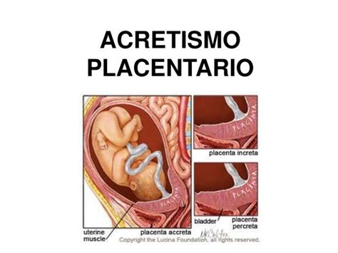 Acretismo Placentario