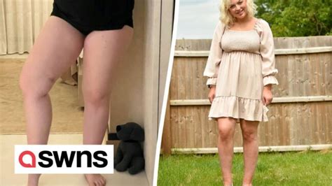 I Was Fat Shamed By Trolls For Having Tree Trunk Legs So Paid 20k To