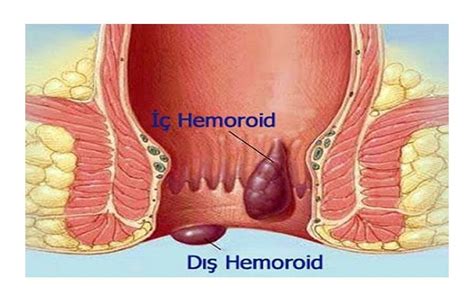 HEMOROİD NEDİR