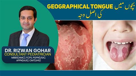 Treatment Of Geographic Tongue Geographic Tongue Treatment YouTube