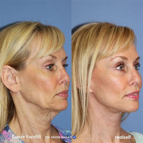 Lower Facelift Before And After Photos Face Lift Before And After