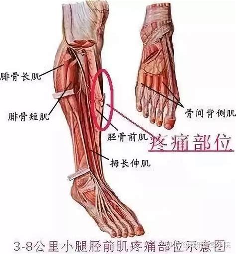 跑步时小腿前侧疼痛不容忽视（1） 知乎