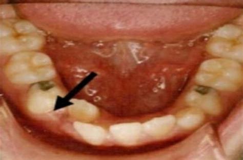 Serial Extraction Dentalbyhadeel Thread From هديل 🕊 Hadeel7m