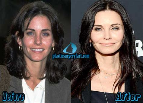 Courteney Cox Plastic Surgery Before and After Photos