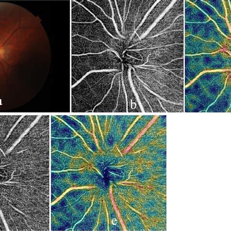 Octa Examinations Of Peripapillary And Optic Disc Vessel Density Of A