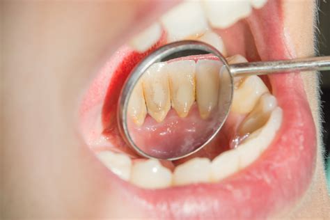 Gum Surgery Everything You Need To Know About Gum Surgery Tooth Treks