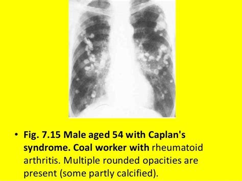 7 Diffuse Lung Disease