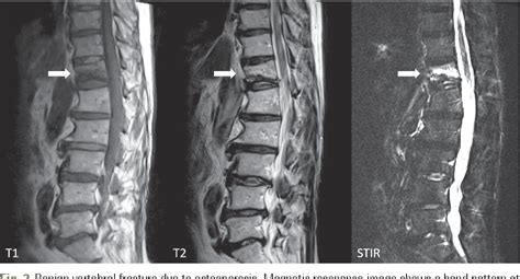 Figure 2 From Discrimination Between Malignant And Benign Vertebral Fractures Using Magnetic