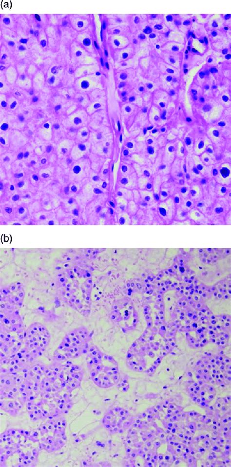 Chromophobe RCC and oncocytoma. (a) Chromophobe RCC, representative ...